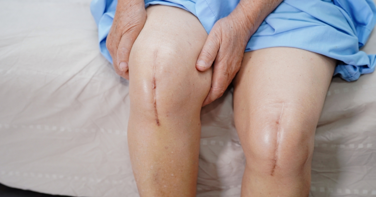 Knee Replacement - Pain Relief