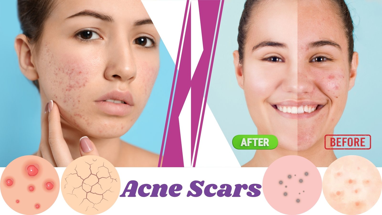 Acne Scars