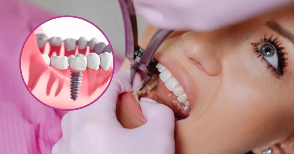 dental implants cost