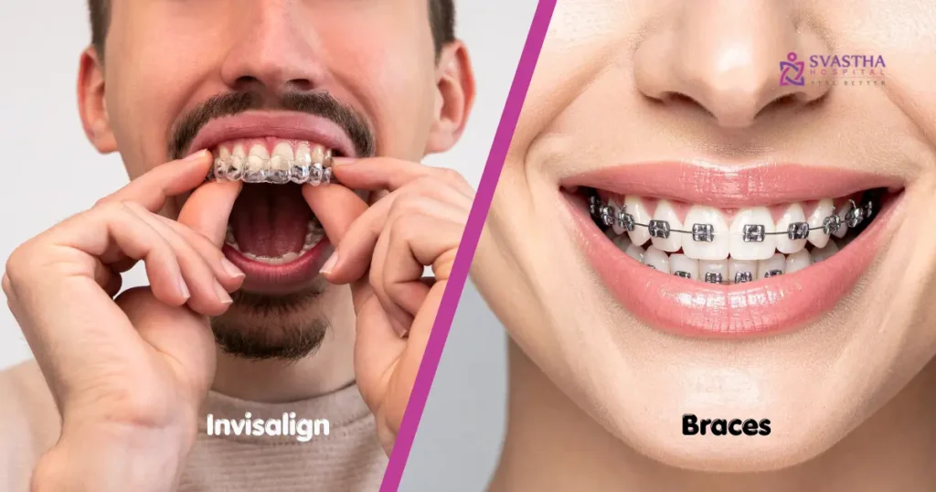 Invisalign vs Braces