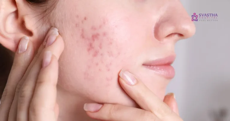 how to get rid of acne scars