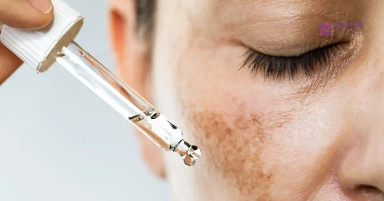 how to treat hyperpigmentation